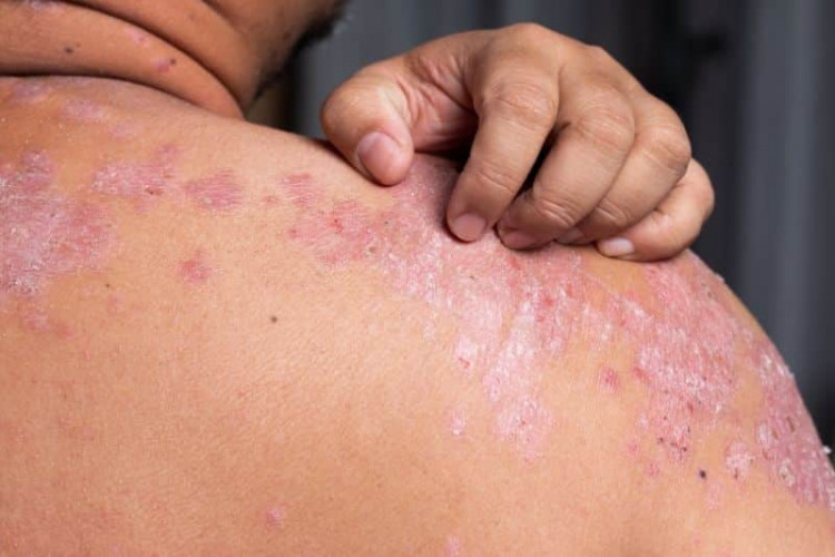 Ayurvedic Psoriasis Treatment Center Kalpetta, Wayanad